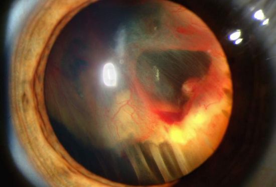 Retinal Detachment_Praveen_eye_hospital